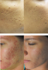 skinpen-before-after